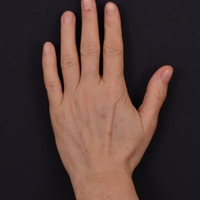 Odstranění pigmentových skvrn na ruce - po ošetření