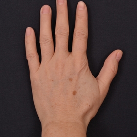 Odstranění pigmentových skvrn na ruce - před ošetřením